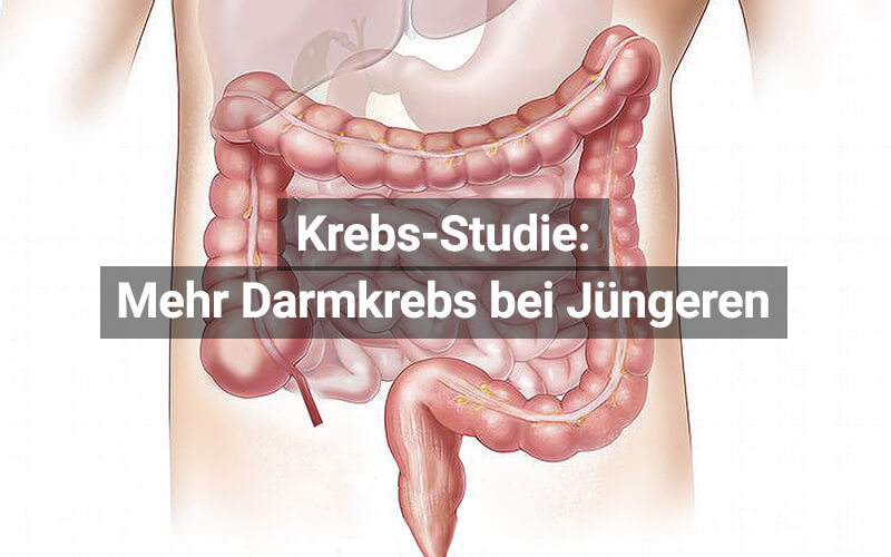 Studie: Mehr Darmkrebs bei jüngeren Menschen