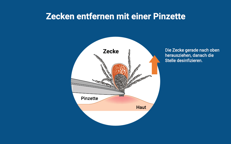 Zeckenbiss Zecken Entfernen Pinzette