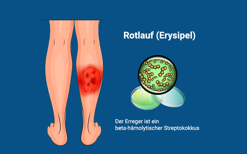 Rotlauf Erysipel Wundrose Erreger Grafik