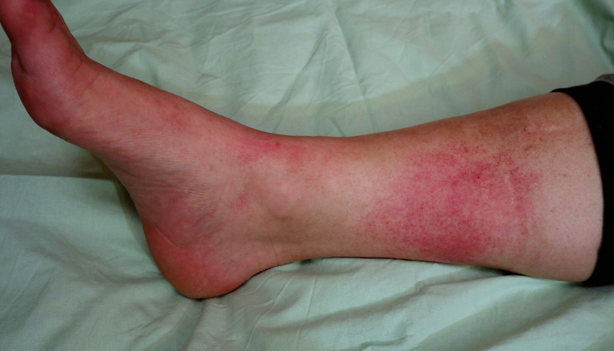 Rotlauf (Erysipel) Ursachen, Anzeichen & Behandlung praktischArzt.at