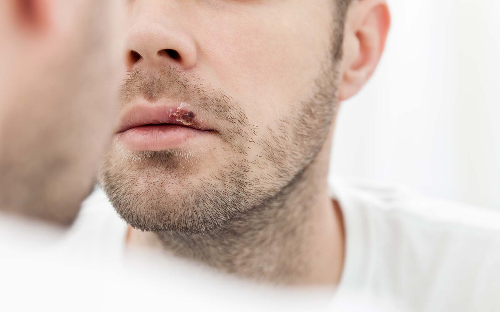 Hausmittel gegen Fieberblase (Lippenherpes)