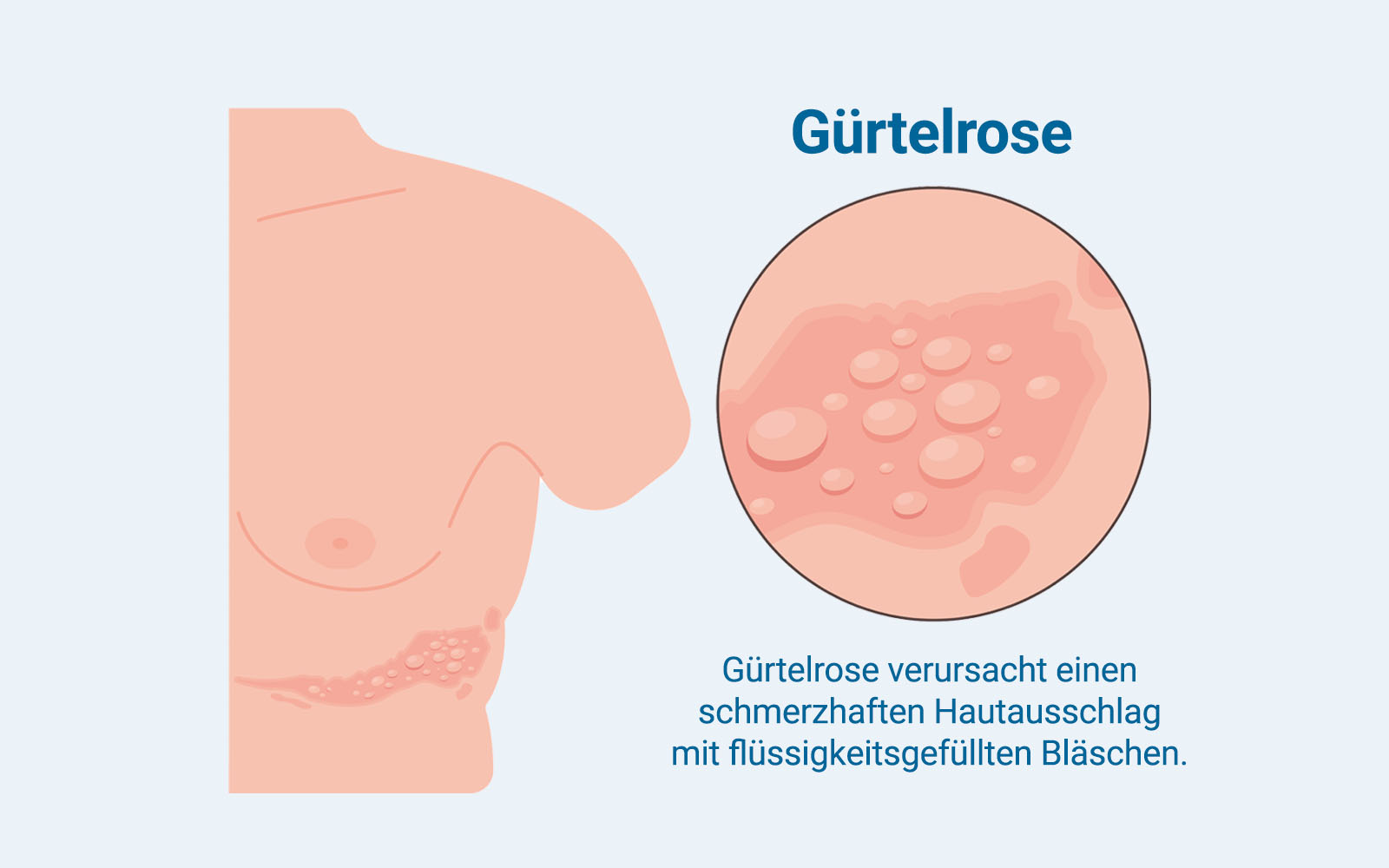 Gürtelrose Herpes Zoster Hautausschlag