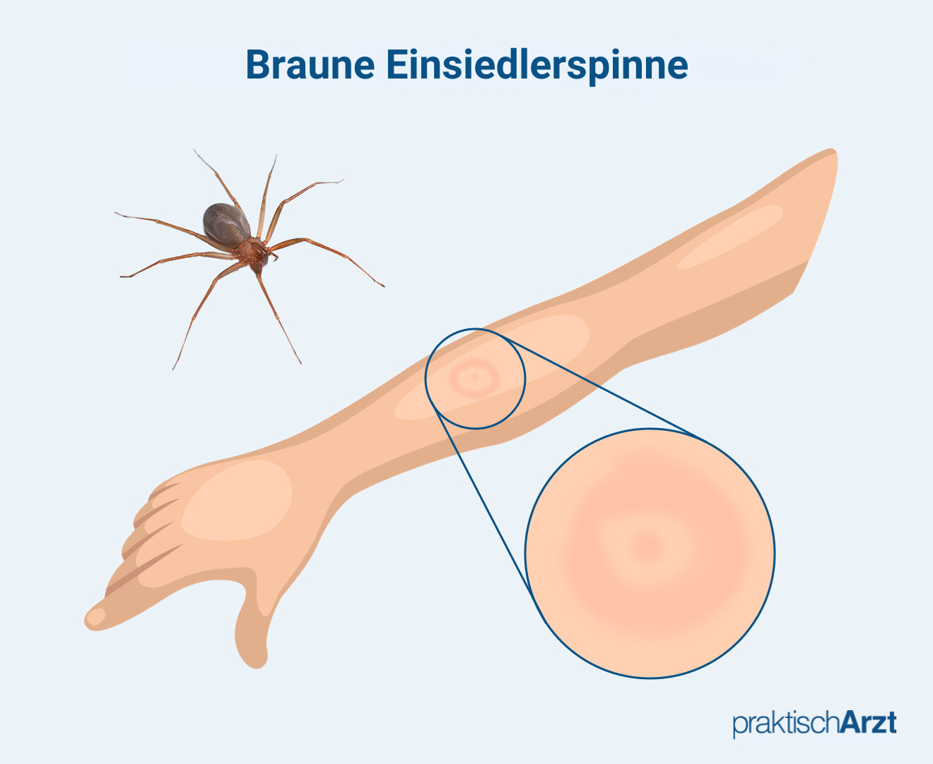 BIss Braune Einsiedlerspinne