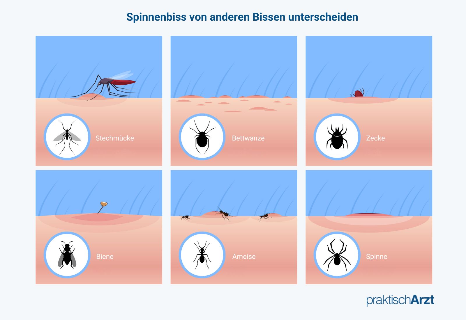 Spinnenbiss Und Bisse Anderer Insekten